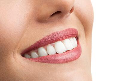 Le blanchiment dentaire : comment fonctionne-t-il ?