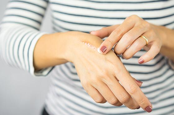 Crème cicatrisante : comment bien la choisir ?
